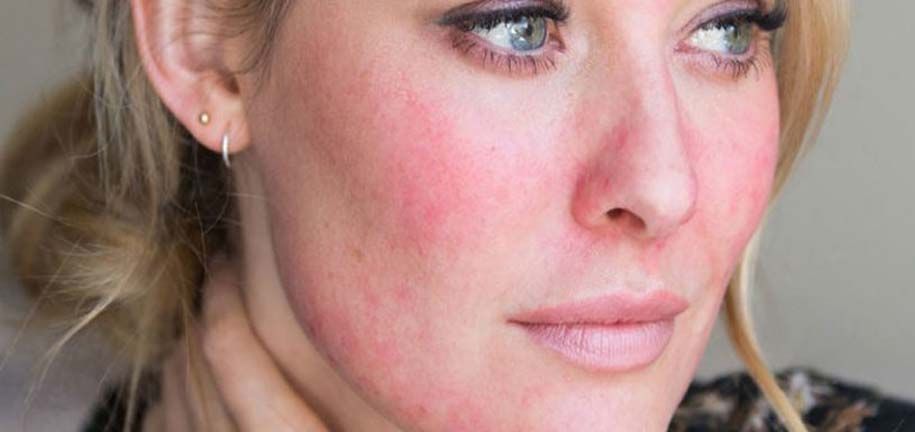 العناية بالبشرة الجافة والمتهيجة