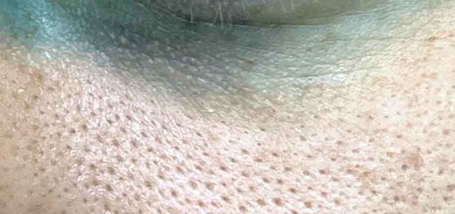 مسام واسعة في الوجه