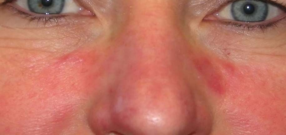 روتين البشرة الدهنية والقشرية