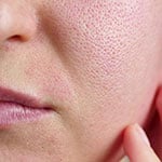 انسداد المسام