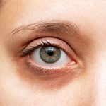 الهالات السوداء حول العين