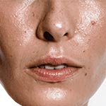 العناية بالبشرة الدهنية