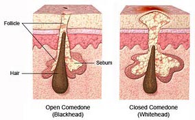 نقاط سوداء ومسامات